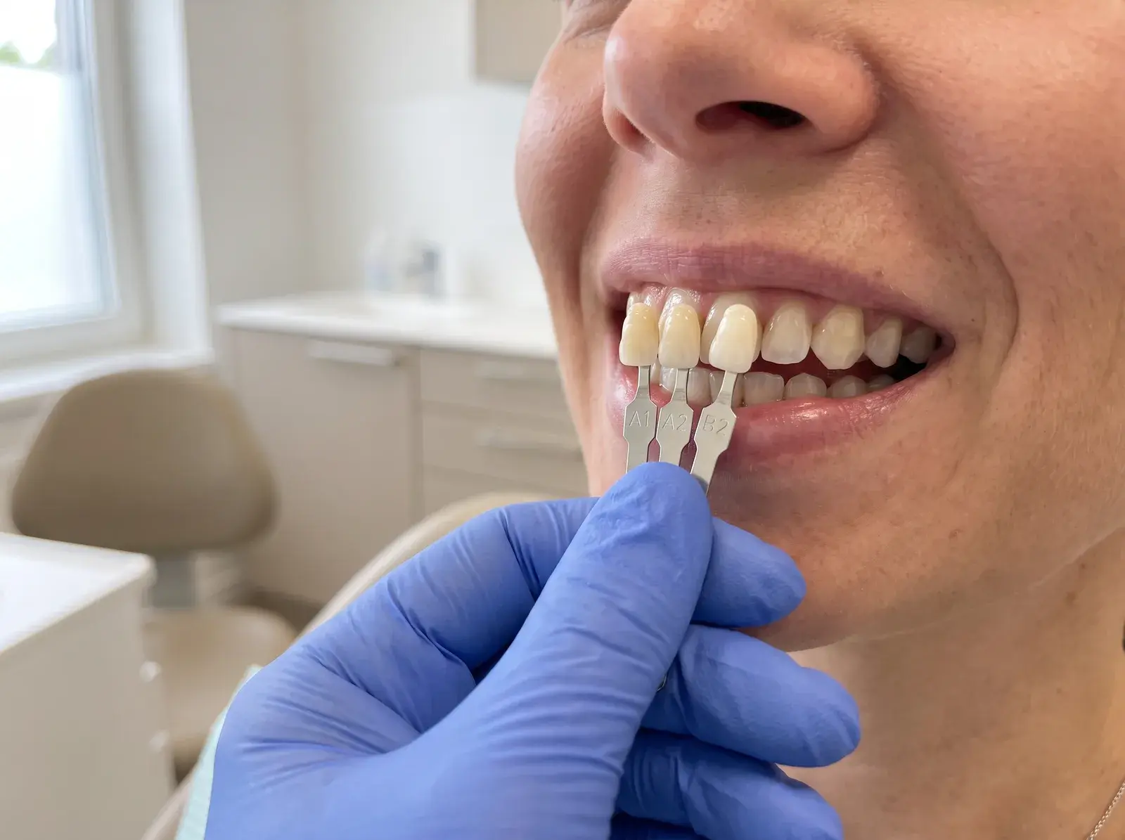 A shade guide held against natural upper teeth, showing several ceramic tabs compared to the patient's own colour